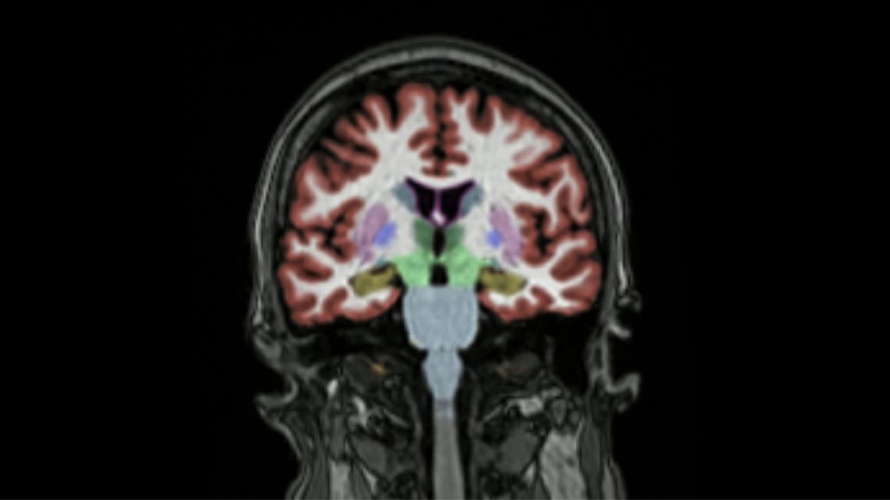 Stimolazione Magnetica Transcranica per pazienti con Alzheimer
