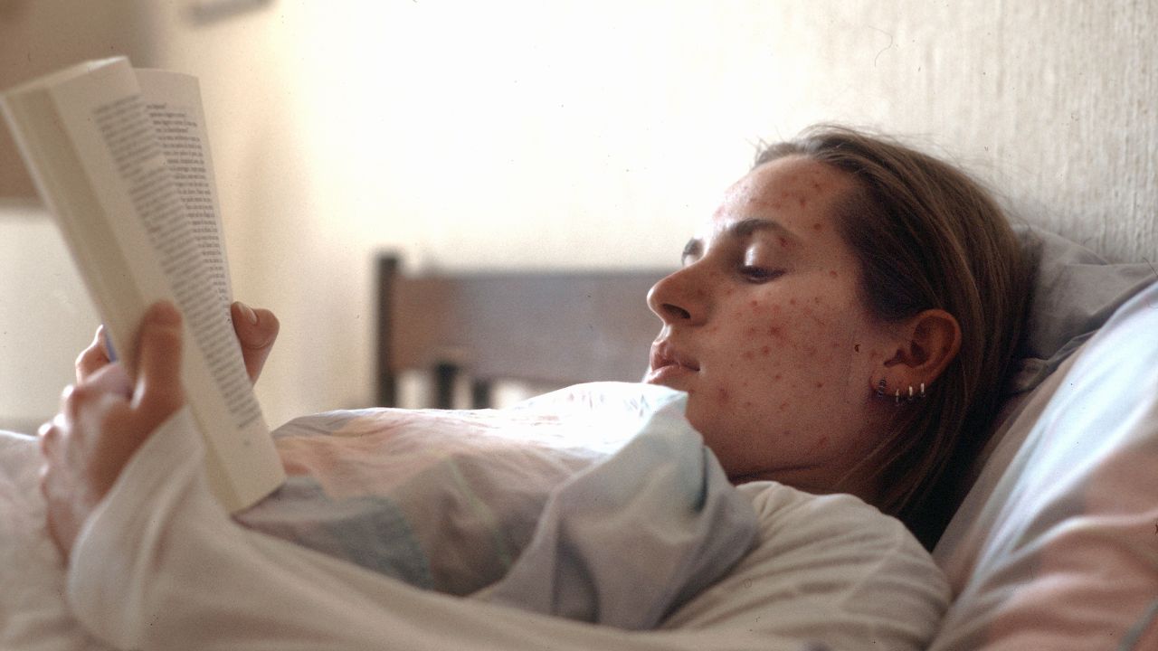 Morbillo, incremento dei casi in Europa nel 2024