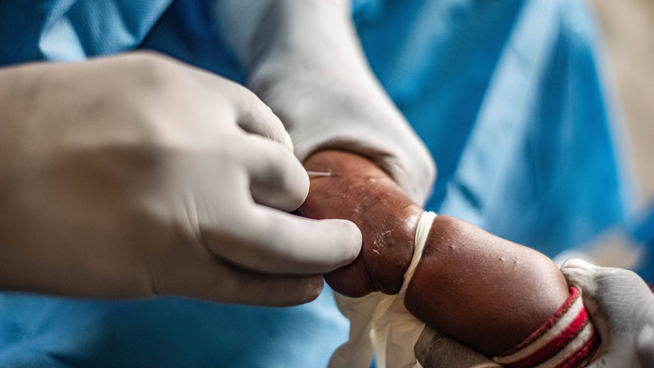 Vaiolo delle scimmie, una minaccia per la salute globale 