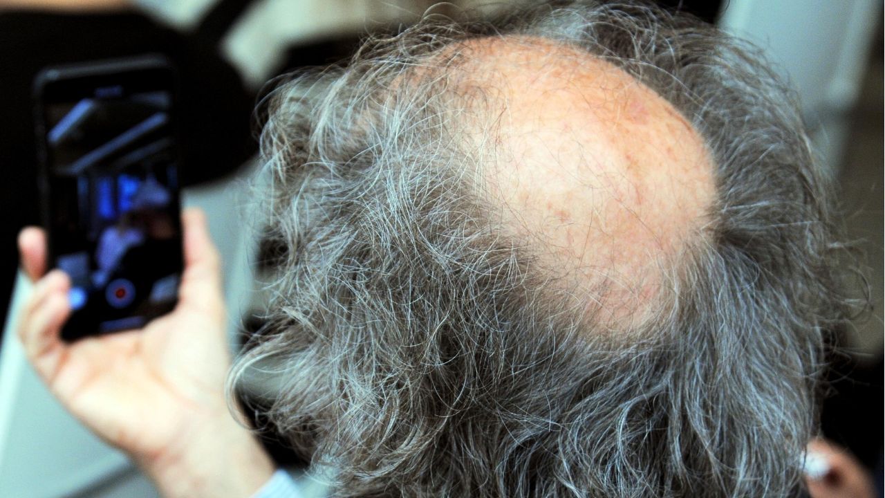 Scoperto il segreto per far ricrescere i capelli grazie alle cellule adipose