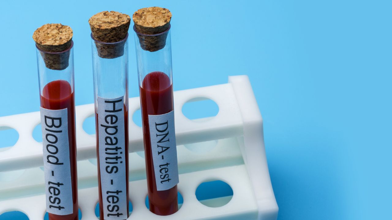 Allarme Epatite A in Campania: 133 casi tra Napoli e provincia. Attenti a cozze e frutti di bosco: l’errore da non fare